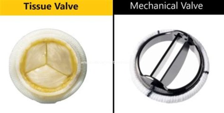 What is INTUITY valve made of?